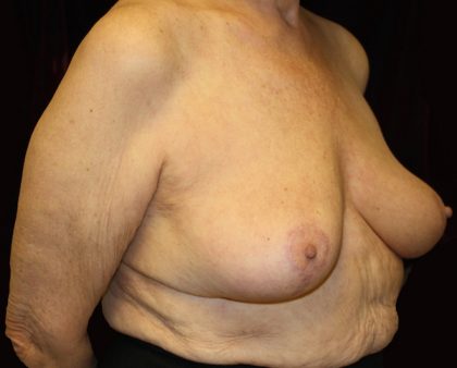 Breast Reduction Before & After Patient #954