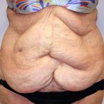 Tummy Tuck Before & After Patient #656