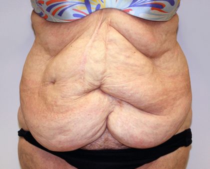 Tummy Tuck Before & After Patient #656