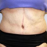 Tummy Tuck Before & After Patient #656