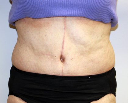 Tummy Tuck Before & After Patient #656