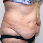 Tummy Tuck Before & After Patient #656