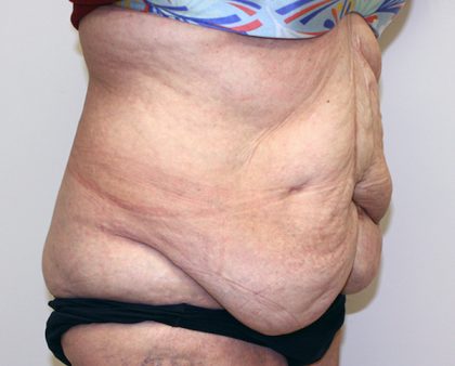 Tummy Tuck Before & After Patient #656