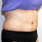 Tummy Tuck Before & After Patient #656