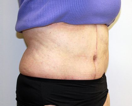 Tummy Tuck Before & After Patient #656