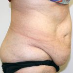 Tummy Tuck Before & After Patient #656