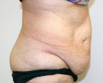 Tummy Tuck Before & After Patient #656