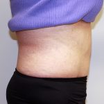 Tummy Tuck Before & After Patient #656