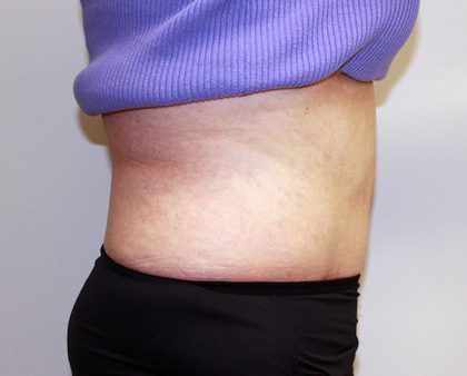 Tummy Tuck Before & After Patient #656