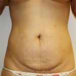 Tummy Tuck Before & After Patient #670