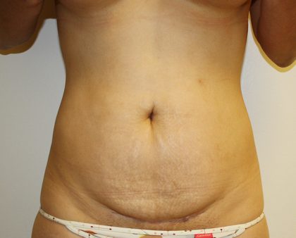 Tummy Tuck Before & After Patient #670