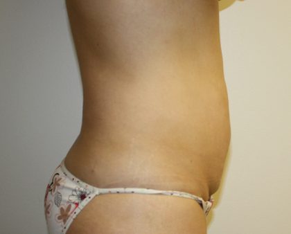 Tummy Tuck Before & After Patient #670