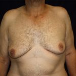 Gynecomastia Before & After Patient #1261