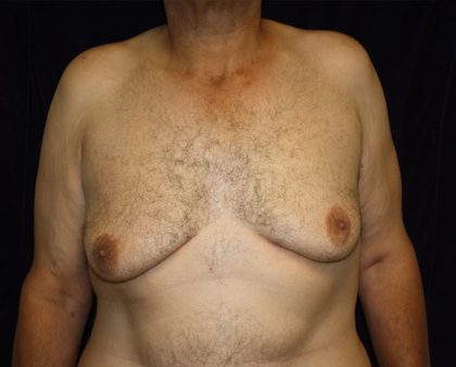 Gynecomastia Before & After Patient #1261