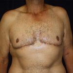 Gynecomastia Before & After Patient #1261