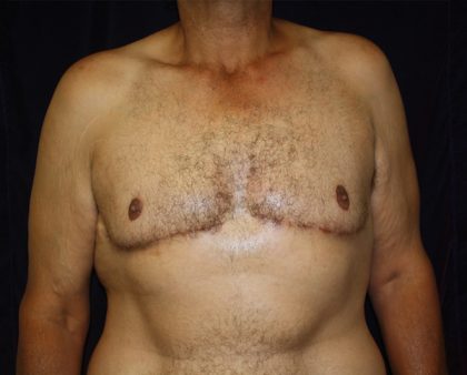 Gynecomastia Before & After Patient #1261