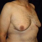 Gynecomastia Before & After Patient #1261