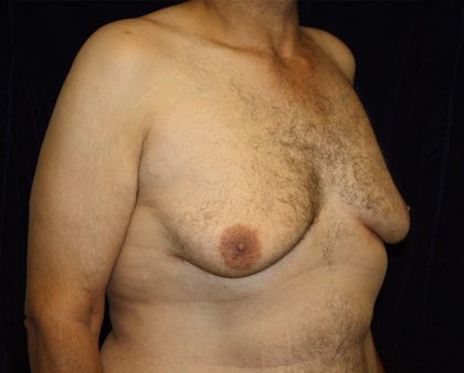 Gynecomastia Before & After Patient #1261