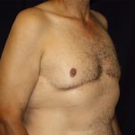 Gynecomastia Before & After Patient #1261