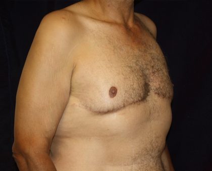 Gynecomastia Before & After Patient #1261