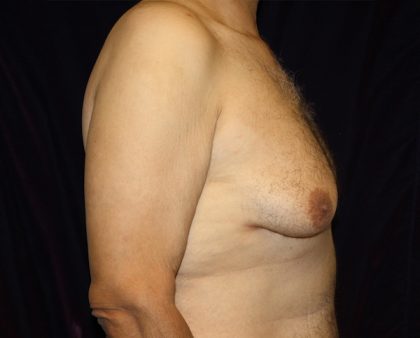 Gynecomastia Before & After Patient #1261