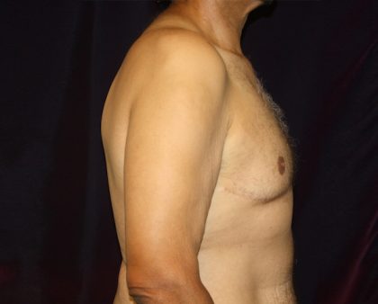 Gynecomastia Before & After Patient #1261