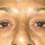 Blepharoplasty Before & After Patient #750