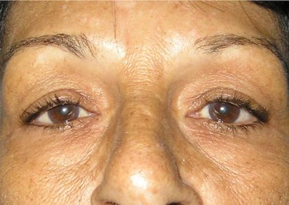 Blepharoplasty Before & After Patient #750