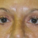 Blepharoplasty Before & After Patient #750