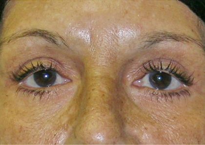 Blepharoplasty Before & After Patient #750