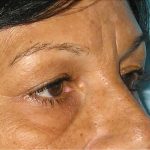 Blepharoplasty Before & After Patient #750