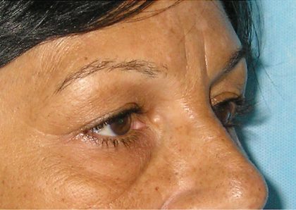 Blepharoplasty Before & After Patient #750