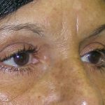 Blepharoplasty Before & After Patient #750