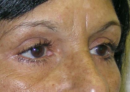 Blepharoplasty Before & After Patient #750