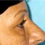 Blepharoplasty Before & After Patient #750