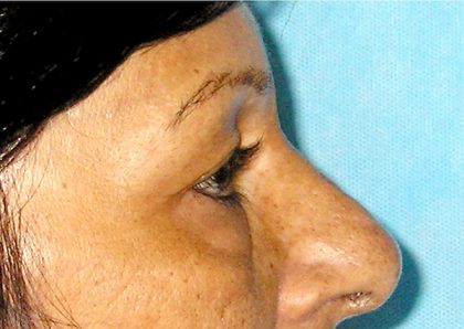 Blepharoplasty Before & After Patient #750