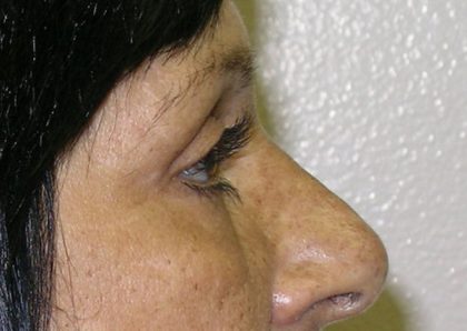 Blepharoplasty Before & After Patient #750