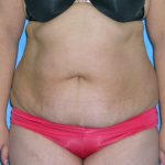 Tummy Tuck Before & After Patient #584