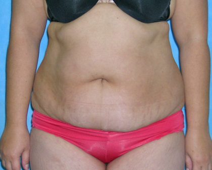 Tummy Tuck Before & After Patient #584