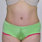 Tummy Tuck Before & After Patient #584