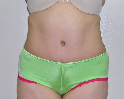 Tummy Tuck Before & After Patient #584