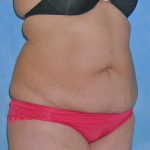 Tummy Tuck Before & After Patient #584