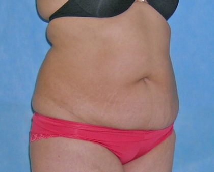 Tummy Tuck Before & After Patient #584