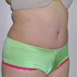 Tummy Tuck Before & After Patient #584