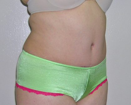 Tummy Tuck Before & After Patient #584