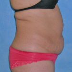 Tummy Tuck Before & After Patient #584