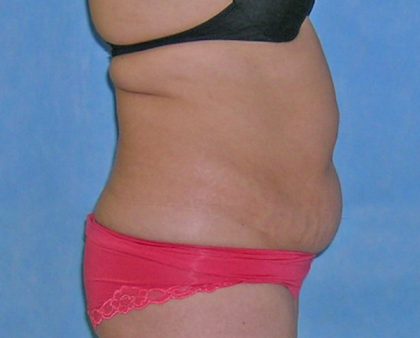 Tummy Tuck Before & After Patient #584