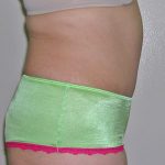 Tummy Tuck Before & After Patient #584