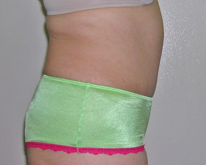 Tummy Tuck Before & After Patient #584