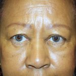 Blepharoplasty Before & After Patient #764